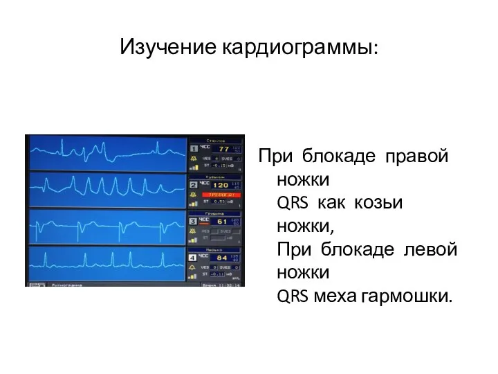 Изучение кардиограммы: При блокаде правой ножки QRS как козьи ножки, При блокаде