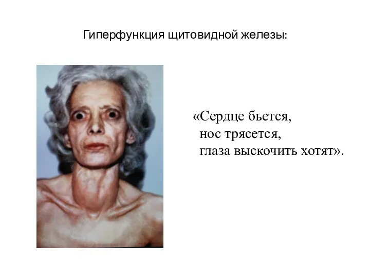 Гиперфункция щитовидной железы: «Сердце бьется, нос трясется, глаза выскочить хотят».