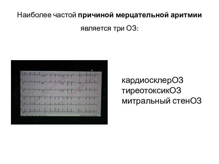 Наиболее частой причиной мерцательной аритмии является три ОЗ: кардиосклерОЗ тиреотоксикОЗ митральный стенОЗ