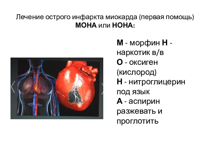 Лечение острого инфаркта миокарда (первая помощь) МОНА или НОНА: М - морфин