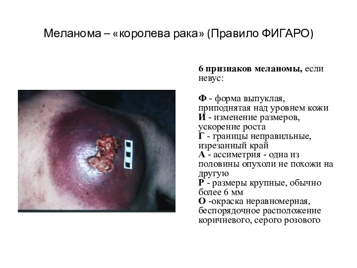 Меланома – «королева рака» (Правило ФИГАРО) 6 признаков меланомы, если невус: Ф