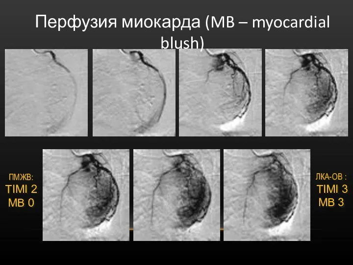 Перфузия миокарда (MB – myocardial blush) ПМЖВ: TIMI 2 MB 0 ЛКА-ОВ