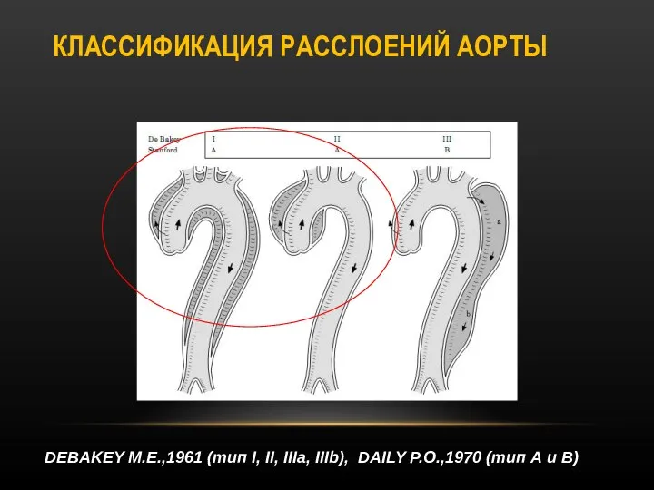 КЛАССИФИКАЦИЯ РАССЛОЕНИЙ АОРТЫ DEBAKEY M.E.,1961 (тип I, II, IIIa, IIIb), DAILY P.O.,1970 (тип А и В)