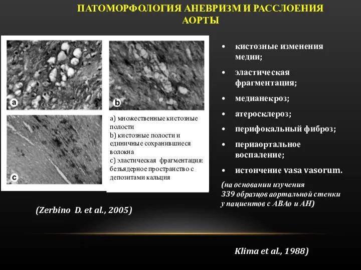 кистозные изменения медии; эластическая фрагментация; медианекроз; атеросклероз; перифокальный фиброз; периаортальное воспаление; истончение