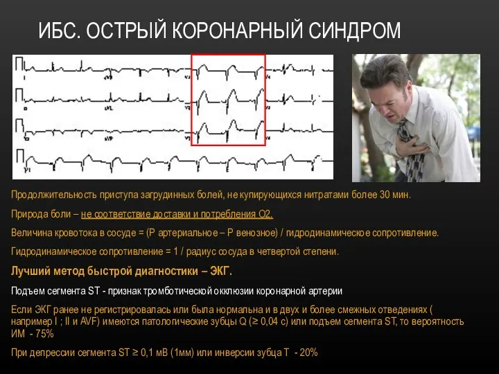 ИБС. ОСТРЫЙ КОРОНАРНЫЙ СИНДРОМ Продолжительность приступа загрудинных болей, не купирующихся нитратами более