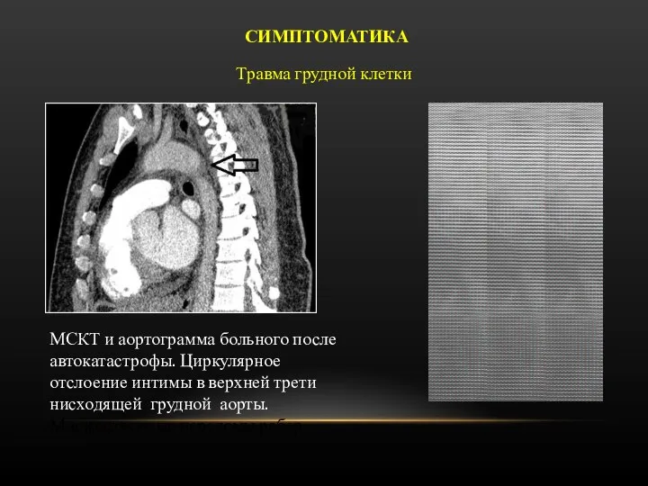 МСКТ и аортограмма больного после автокатастрофы. Циркулярное отслоение интимы в верхней трети