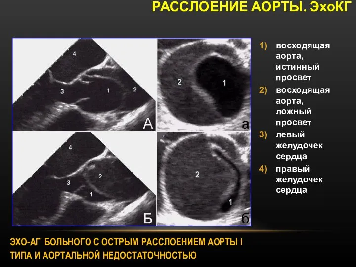 ЭХО-АГ БОЛЬНОГО С ОСТРЫМ РАССЛОЕНИЕМ АОРТЫ I ТИПА И АОРТАЛЬНОЙ НЕДОСТАТОЧНОСТЬЮ РАССЛОЕНИЕ