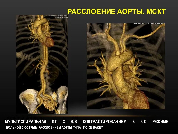 РАССЛОЕНИЕ АОРТЫ. МСКТ МУЛЬТИСПИРАЛЬНАЯ КТ С В/В КОНТРАСТИРОВАНИЕМ В 3-D РЕЖИМЕ БОЛЬНОЙ