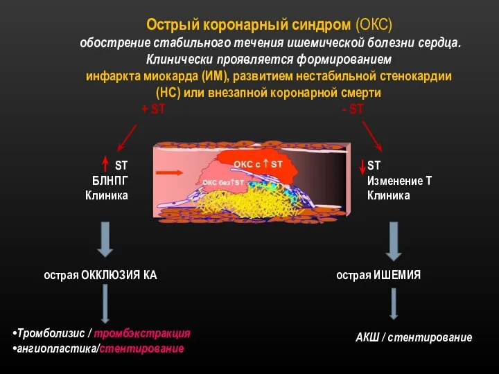 Острый коронарный синдром (ОКС) обострение стабильного течения ишемической болезни сердца. Клинически проявляется