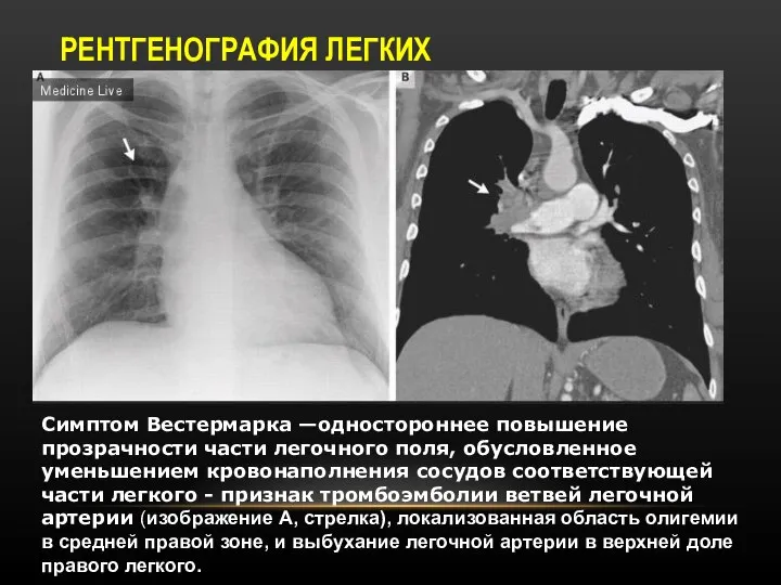 РЕНТГЕНОГРАФИЯ ЛЕГКИХ Симптом Вестермарка —одностороннее повышение прозрачности части легочного поля, обусловленное уменьшением