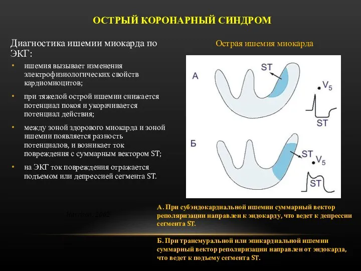 Диагностика ишемии миокарда по ЭКГ: ишемия вызывает изменения электрофизиологических свойств кардиомиоцитов; при