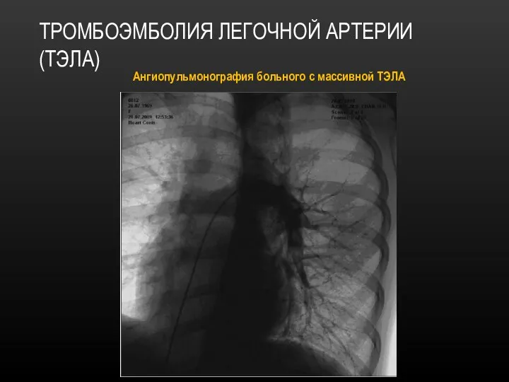 ТРОМБОЭМБОЛИЯ ЛЕГОЧНОЙ АРТЕРИИ (ТЭЛА) Ангиопульмонография больного с массивной ТЭЛА