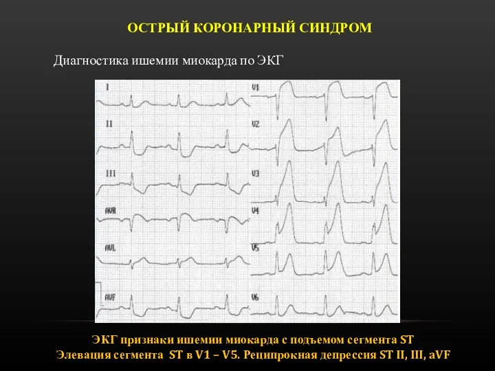 ОСТРЫЙ КОРОНАРНЫЙ СИНДРОМ Диагностика ишемии миокарда по ЭКГ ЭКГ признаки ишемии миокарда