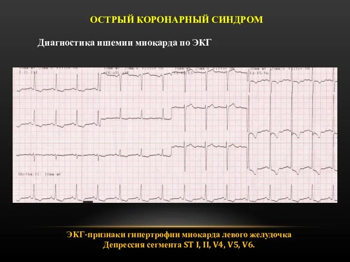 ЭКГ-признаки гипертрофии миокарда левого желудочка Депрессия сегмента ST I, II, V4, V5,