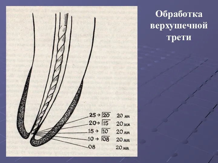 Обработка верхушечной трети