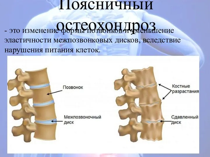 Поясничный остеохондроз - это изменение формы позвонков и уменьшение эластичности межпозвонковых дисков, вследствие нарушения питания клеток.