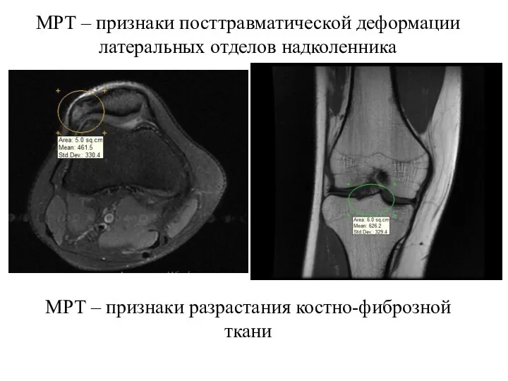 МРТ – признаки посттравматической деформации латеральных отделов надколенника МРТ – признаки разрастания костно-фиброзной ткани
