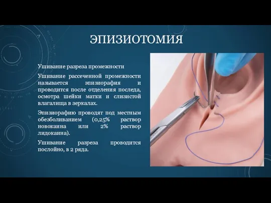 Ушивание разреза промежности Ушивание рассеченной промежности называется эпизиорафия и проводится после отделения