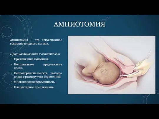 АМНИОТОМИЯ Амниотомия – это искусственное вскрытие плодного пузыря. Противопоказания к амниотомии Предлежание