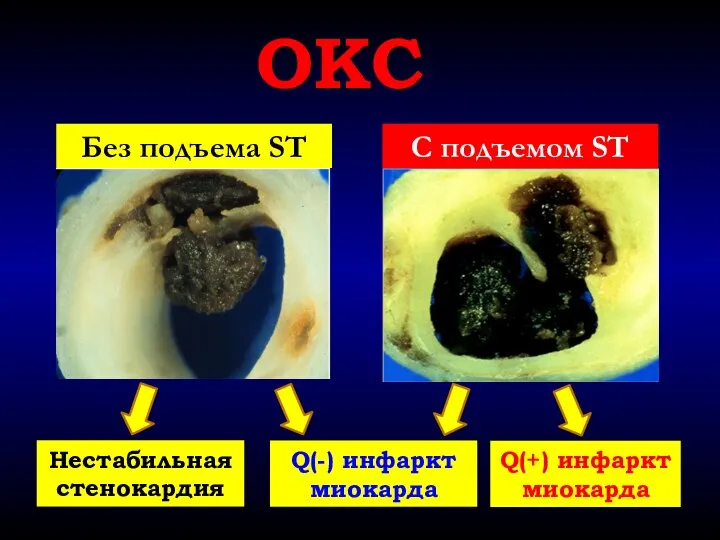 Без подъема ST C подъемом ST ОКС Нестабильная стенокардия Q(-) инфаркт миокарда Q(+) инфаркт миокарда