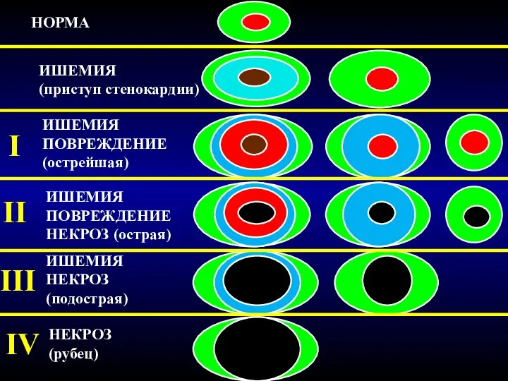 НОРМА ИШЕМИЯ (приступ стенокардии) ИШЕМИЯ ПОВРЕЖДЕНИЕ (острейшая) ИШЕМИЯ ПОВРЕЖДЕНИЕ НЕКРОЗ (острая) ИШЕМИЯ