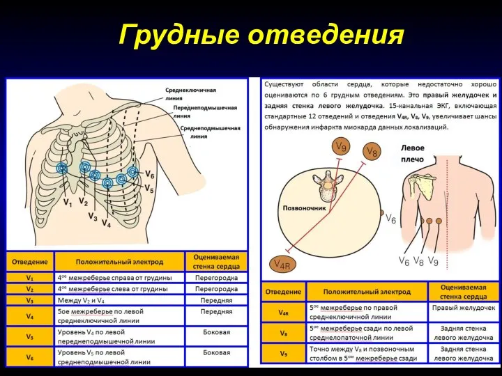 Грудные отведения