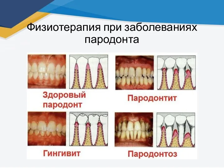 Физиотерапия при заболеваниях пародонта