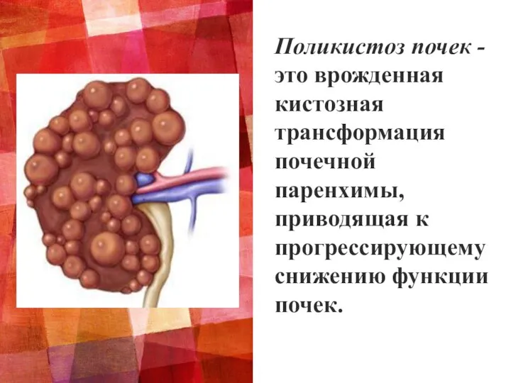 Поликистоз почек - это врожденная кистозная трансформация почечной паренхимы, приводящая к прогрессирующему снижению функции почек.