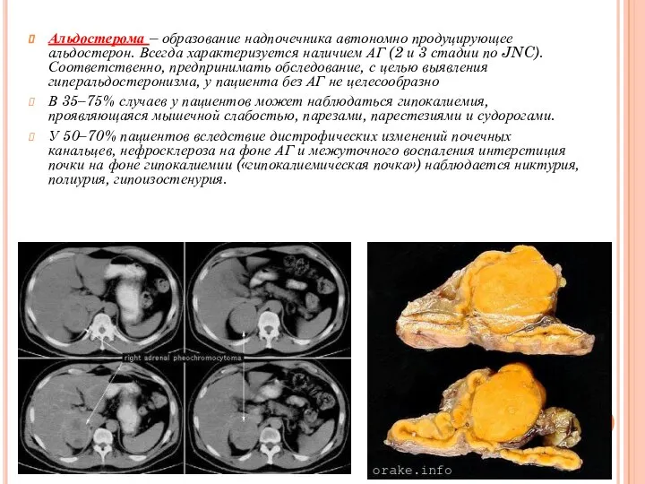 Альдостерома – образование надпочечника автономно продуцирующее альдостерон. Всегда характеризуется наличием АГ (2