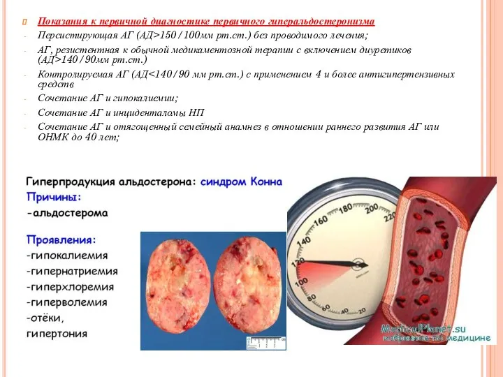 Показания к первичной диагностике первичного гиперальдостеронизма Персистирующая АГ (АД>150/100мм рт.ст.) без проводимого