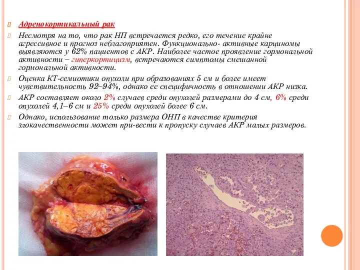 Адренокортикальный рак Несмотря на то, что рак НП встречается редко, его течение