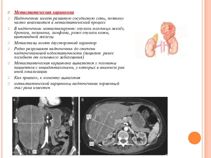 Метастатическая карцинома Надпочечник имеет развитую сосудистую сеть, поэтому часто вовлекается в метастатический