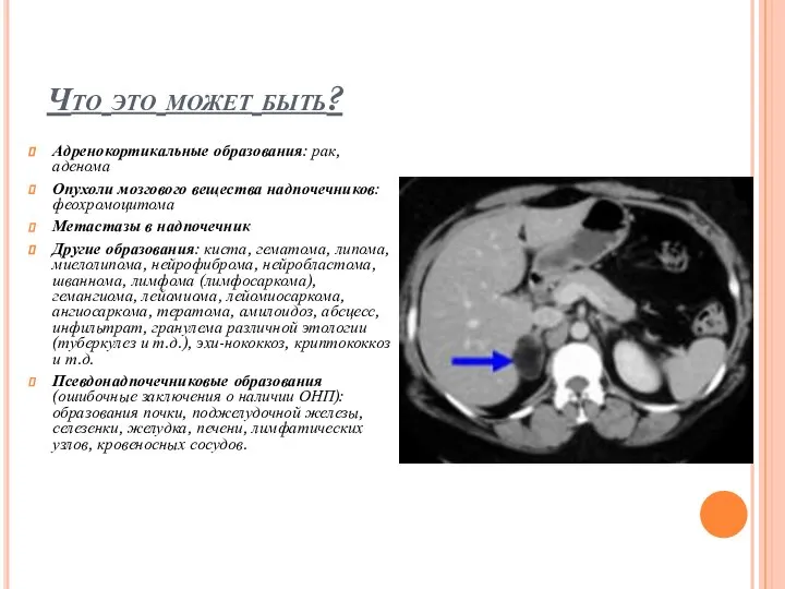 Что это может быть? Адренокортикальные образования: рак, аденома Опухоли мозгового вещества надпочечников: