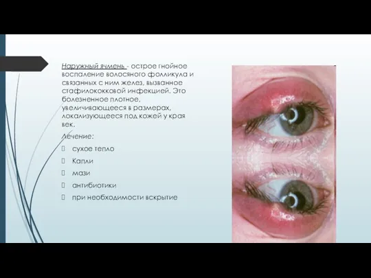 Наружный ячмень - острое гнойное воспаление волосяного фолликула и связанных с ним