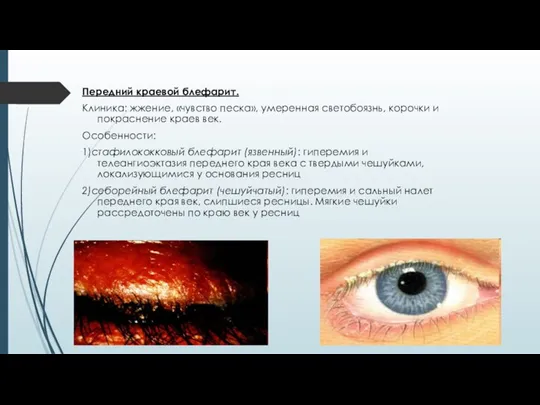 Передний краевой блефарит. Клиника: жжение, «чувство песка», умеренная светобоязнь, корочки и покраснение