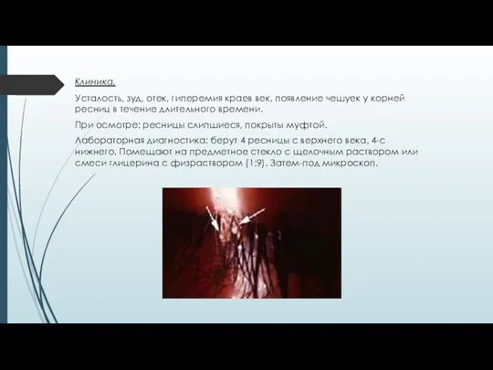 Клиника. Усталость, зуд, отек, гиперемия краев век, появление чешуек у корней ресниц