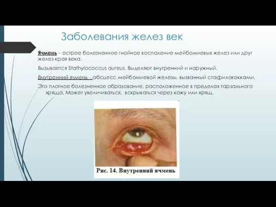 Заболевания желез век Ячмень – острое болезненное гнойное воспаление мейбомиевых желез или