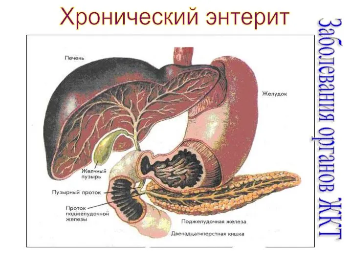 Хронический энтерит Заболевания органов ЖКТ