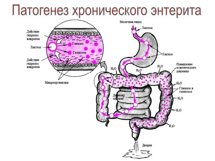 Патогенез хронического энтерита