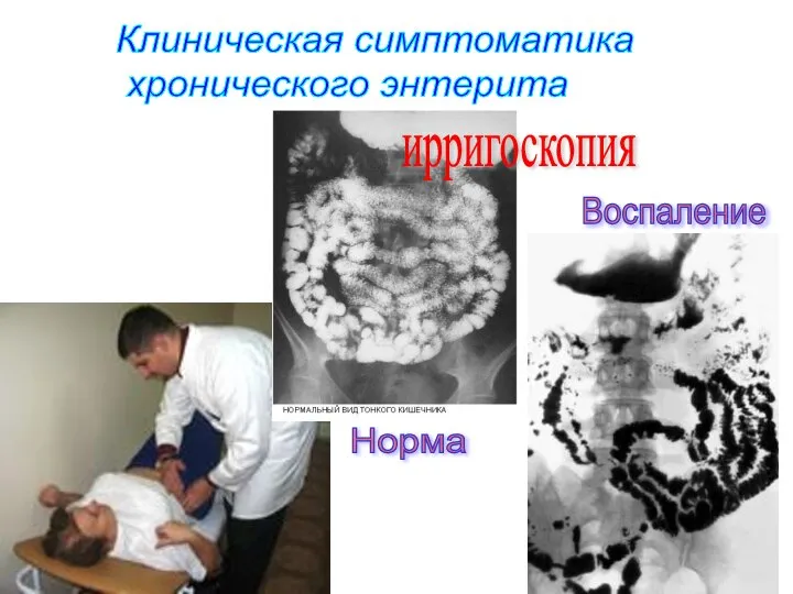 Клиническая симптоматика хронического энтерита Норма Воспаление ирригоскопия