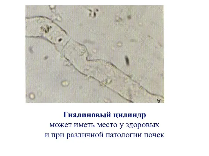 Гиалиновый цилиндр может иметь место у здоровых и при различной патологии почек