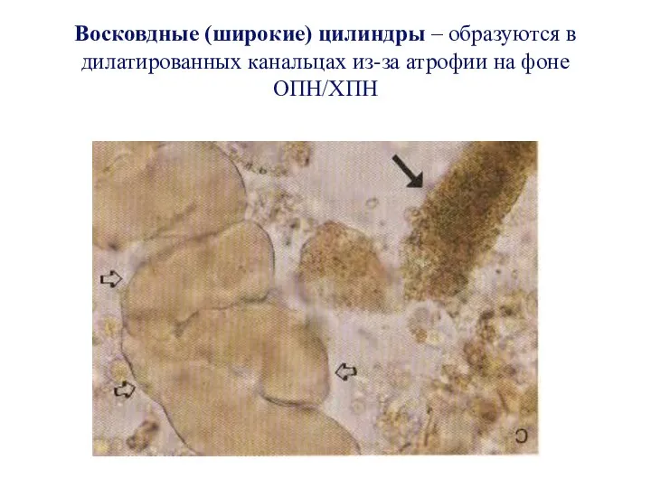 Восковдные (широкие) цилиндры – образуются в дилатированных канальцах из-за атрофии на фоне ОПН/ХПН