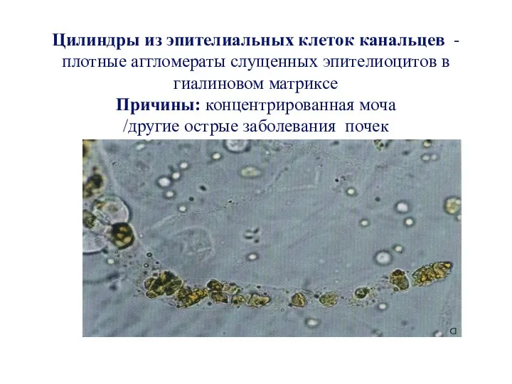 Цилиндры из эпителиальных клеток канальцев -плотные аггломераты слущенных эпителиоцитов в гиалиновом матриксе