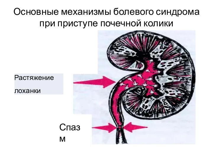 Основные механизмы болевого синдрома при приступе почечной колики Спазм