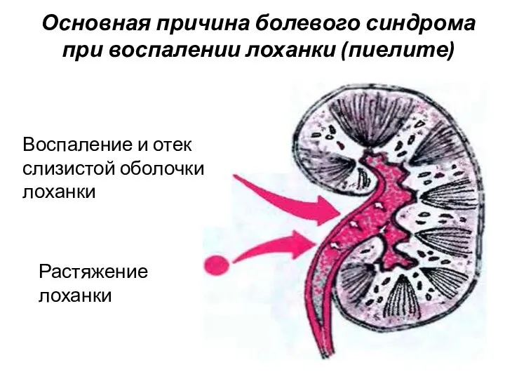 Основная причина болевого синдрома при воспалении лоханки (пиелите) Растяжение лоханки Воспаление и отек слизистой оболочки лоханки