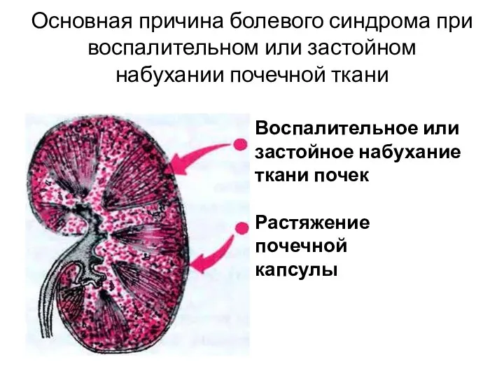 Основная причина болевого синдрома при воспалительном или застойном набухании почечной ткани Воспалительное