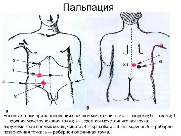 Пальпация Болевые точки при заболеваниях почек и мочеточников: а — спереди; б