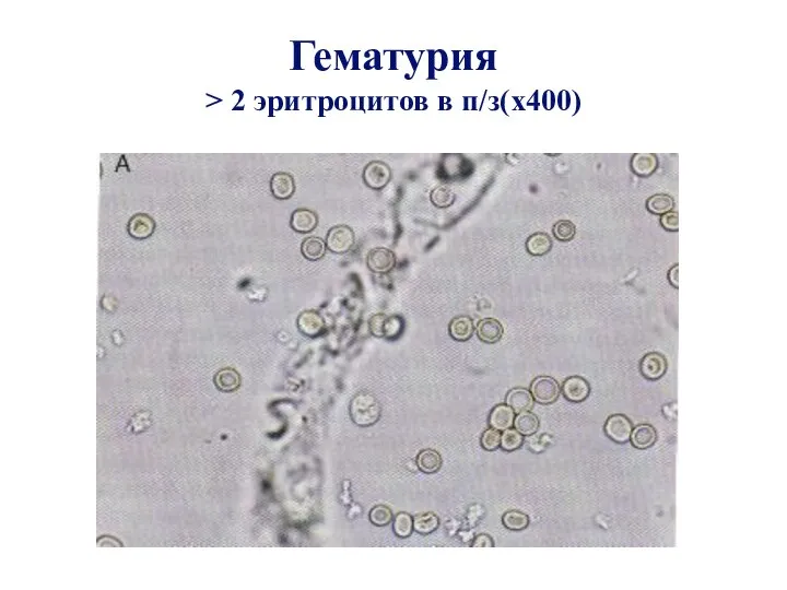 Гематурия > 2 эритроцитов в п/з(x400)