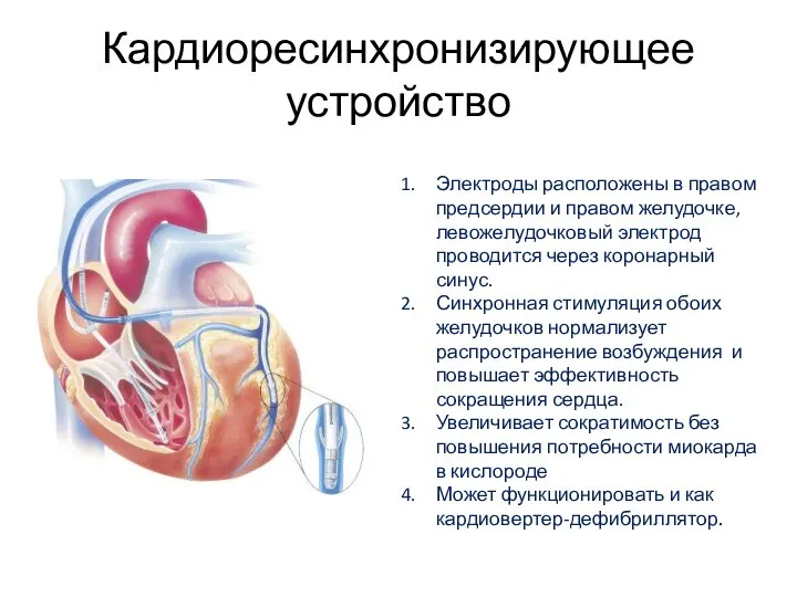 Кардиоресинхронизирующее устройство Электроды расположены в правом предсердии и правом желудочке, левожелудочковый электрод