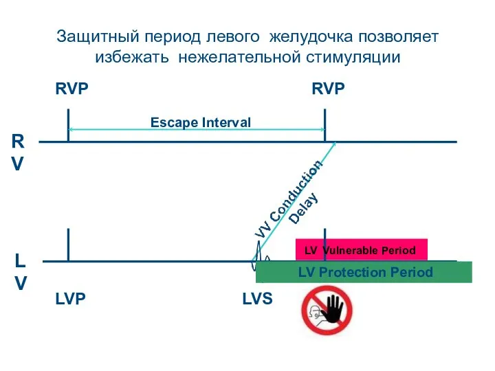 RV RVP LV LVS LVP RVP Escape Interval Защитный период левого желудочка